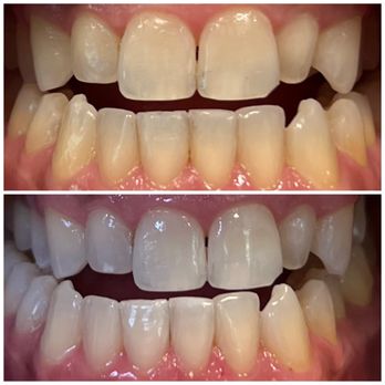 Deebeaut - Before & After - Teeth Whitening Near Me Deebeaut - Before & After - Teeth Whitening Near Me