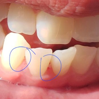 Gold Coast Dental Brea - Cut and bruised gums from the assistant that started to clean my teeth. - Orthodontists Near Me - Brea, California Gold Coast Dental Brea - Cut and bruised gums from the assistant that started to clean my teeth. - Orthodontists Near Me - Brea, California