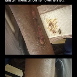 King Of Prussia Nursing And Rehabilitation - A injury that my mother got while in their care. That I wasn't notified of