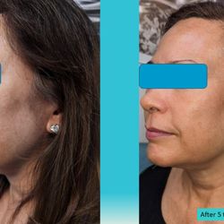 Joyful Living Aesthetics and Regenerative Medicine - Trilift Non-surgical Facelift like effects. Tones, tightens, lifts, smooths skin tone, corrects pigmentation.