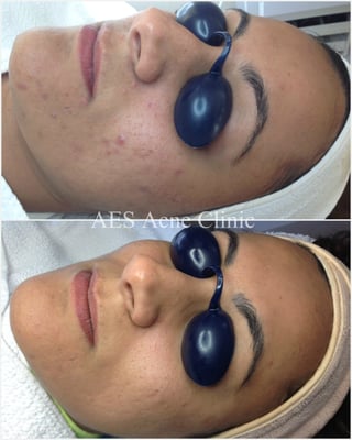 AES Acne Clinic by null