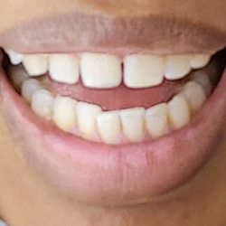 West Oahu Dental Center - Fixed tooth