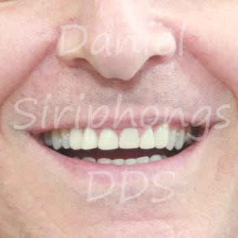 Daniel Siriphongs, DDS - Composite veneers - done in one appointment. Take home bleaching as well. - General Dentistry Near Me - Sulphur Springs, Texas Daniel Siriphongs, DDS - Composite veneers - done in one appointment. Take home bleaching as well. - General Dentistry Near Me - Sulphur Springs, Texas