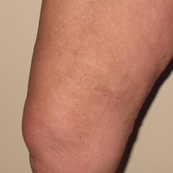 Capitol Vein & Laser Centers - After Venefit procedure. Treatment for varicose veins.