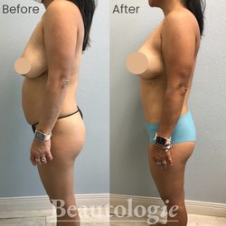 Beautologie Cosmetic Surgery, Medical Aesthetics & Wellness - Mommy Makeover Bilateral Breast lift + Tummy Tuck Before and After by Dr. Bryan Curtis