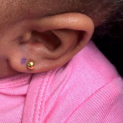 Pediatric Center for Wellness - Botched ear piercing.