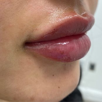 LaserAway - Side view of lips - Laser Hair Removal Near Me - Walnut Creek, California LaserAway - Side view of lips - Laser Hair Removal Near Me - Walnut Creek, California
