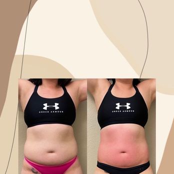 B Sculpted - Before & After: 10 sessions VL! - Body Contouring Near Me - San Ramon, California