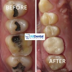 All Dental - Riverview need a dentist?
Tired of silver fillings?
We only do tooth colored filings for all of our patients.