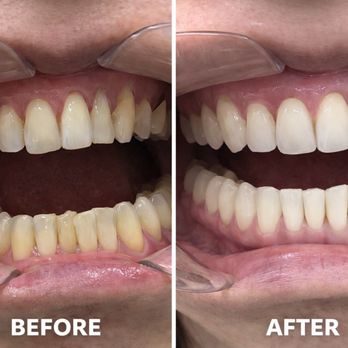 ION Dental Group - Before and after results following 6 months of Invisalign treatment, showing improved alignment and smile aesthetics - Orthodontists Near Me - Corona, California ION Dental Group - Before and after results following 6 months of Invisalign treatment, showing improved alignment and smile aesthetics - Orthodontists Near Me - Corona, California