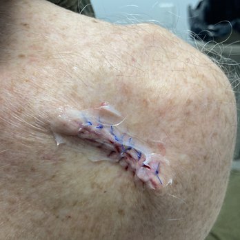 Schweiger Dermatology Group - Moh surgery repair. - Dermatologists Near Me - Great Neck, New York