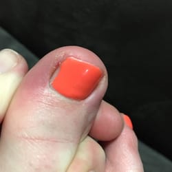 Fashion Nails - Beyond patchy polish, cut swollen toe.