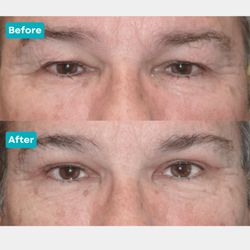 Jordan Conger, MD - Eyesthetica Valencia - This patient underwent an upper blepharoplasty by Dr. Conger