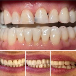 Veneers Before and After