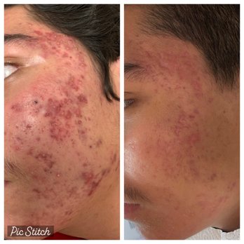 Daisy MD Care - Acne Removal with Beginning of Scar Removal - Skin Care Near Me - Downey, California Daisy MD Care - Acne Removal with Beginning of Scar Removal - Skin Care Near Me - Downey, California