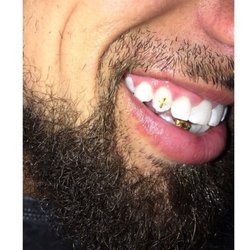 Tooth Cavair; No pain, No Drilling, Professionally Bonded