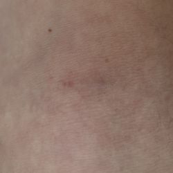 Alex Lau Acupuncture - Bruised forearm from acupuncture being too rough