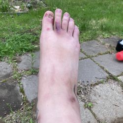 Nail Trix - I had to take off pretty much my entire toe nail my suspicion is they were not properly cleaning their tools