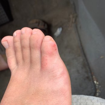 Nice Touch Nail - Area where she scrubbed too hard over a rash. - Nail Salons Near Me - Littleton, Colorado