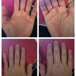 Orthopedic + Fracture Specialists - 5 1/2 weeks post-op carpal tunnel & middle trigger finger release on right hand.