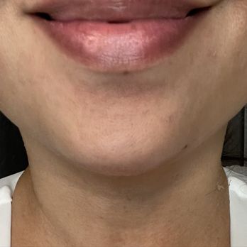 Rejuvie Skincare - Hydra facial and RF post VI Peel - Day 8 - Skin Care Near Me - Glendale, California Rejuvie Skincare - Hydra facial and RF post VI Peel - Day 8 - Skin Care Near Me - Glendale, California