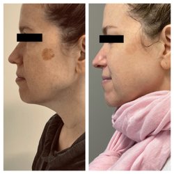 Weight Loss & Skin Center - Hiper pigmentation/ Sun damage/ Age spot treatment by IPL light.
No down time
No pain
FDA approved