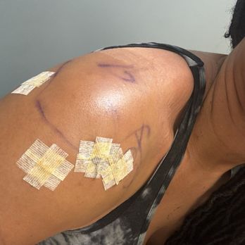 Fremont Surgery Center - Stitches out 2weeks later - Medical Centers Near Me - Fremont, California Fremont Surgery Center - Stitches out 2weeks later - Medical Centers Near Me - Fremont, California