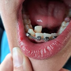 Swapp Orthodontics - The tooth that had to be moved forward