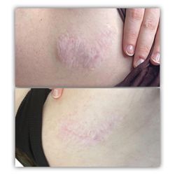 The Touch - Inkless Scar Camouflage. Before and After from one treatment
