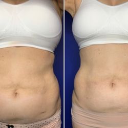 The Total You Medical Spa - TruSculpt iD Before and After