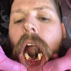Route 66 Dental Implants - After sutures...