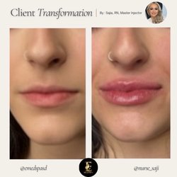Instantly after lip augmentation.