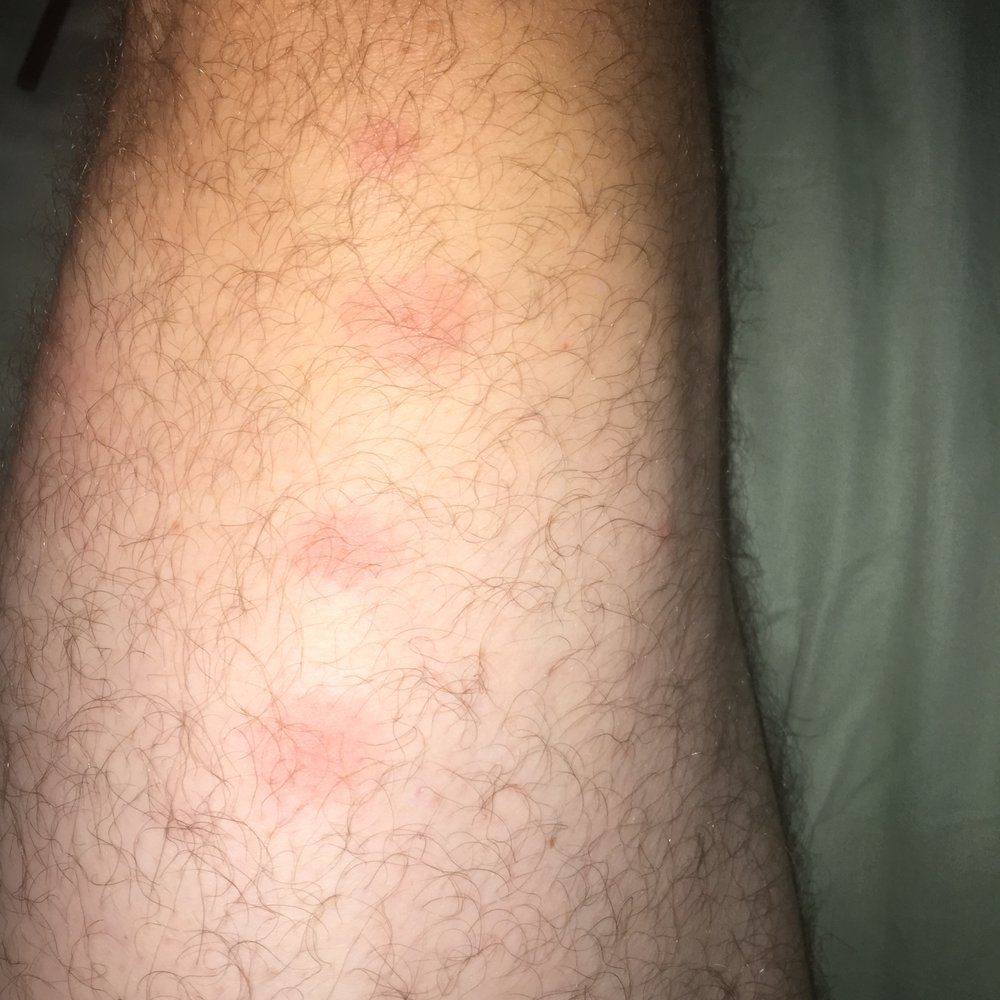 BedBugs found in two rooms days apart from one another. BedBugs found in two rooms days apart from one another.