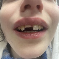 Wrigleyville Dental - Broken tooth