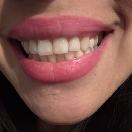 After! No more gaps. Crowns and implants in place, front tooth chip filled. Teeth clean!