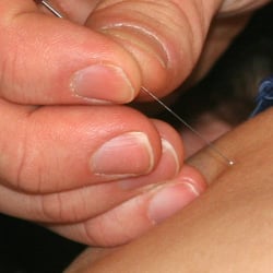 Insight - Natural Medicine, Martial Arts & Fitness - Acupuncture