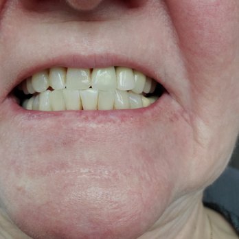 Gently White - After - Teeth Whitening Near Me - Rocklin, California Gently White - After - Teeth Whitening Near Me - Rocklin, California