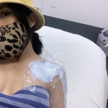 LaserAway - Numbing cream before the tattoo removal process. (First session) - Laser Hair Removal Near Me - Chula Vista, California