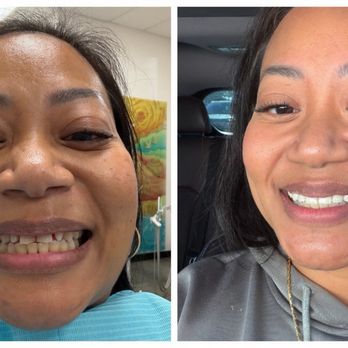 Long Beach Family Dentist - My before and after. - Cosmetic Dentists Near Me - Long Beach, California Long Beach Family Dentist - My before and after. - Cosmetic Dentists Near Me - Long Beach, California