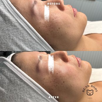 Bear Body Skin - Lifting and Radio Frequency facelift - Body Contouring Near Me - Fullerton, California Bear Body Skin - Lifting and Radio Frequency facelift - Body Contouring Near Me - Fullerton, California