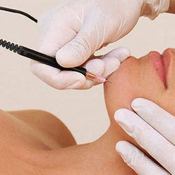 Diane Mancini Electrolysis