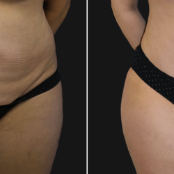 Munique Maia, MD - Maia Plastic Surgery - Before and After: Patient's Tummy Tuck, Lipo, and Breast Implant Removal & Lift with Dr. Maia in Tysons Corner, VA