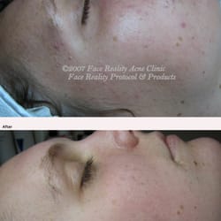 Della Bella Acne & Skin Care Center - Non-Inflamed Before and After