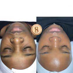Bare Skintentions - Before and after of chemical peel treatments. Photos taken on different dates.