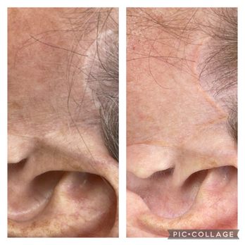 About Face - Facelift scar camo - Medical Spas Near Me - Chattanooga, Tennessee About Face - Facelift scar camo - Medical Spas Near Me - Chattanooga, Tennessee