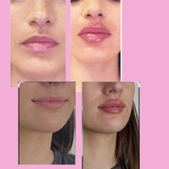 Definitive Beauty - Lip Filler Before and After - Weight Loss Centers Near Me - Alafaya, Florida Definitive Beauty - Lip Filler Before and After - Weight Loss Centers Near Me - Alafaya, Florida