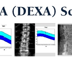 Florida Diagnostic Imaging - Dexa scans ALSO KNOWN AS bone density -HELPS MONIOTOR HEALTH