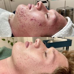 Clear Skin Solutions - Before and after