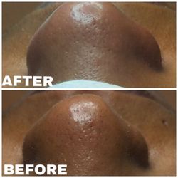 Comprehensive Pain Management - Deep pores cleaning