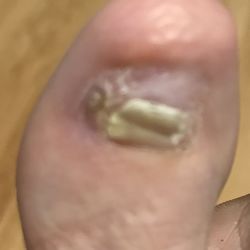 Roseburg Foot and Ankle Specialists - This is what I have now from an ingrown toenail procedure From Roseburg Foot and Ankle. Left side pain continues to be an issue. Extreme!